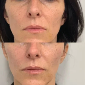 uklanjanje podocnjaka