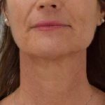 nakon profhilo tretmana