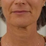 pre profhilo tretmana